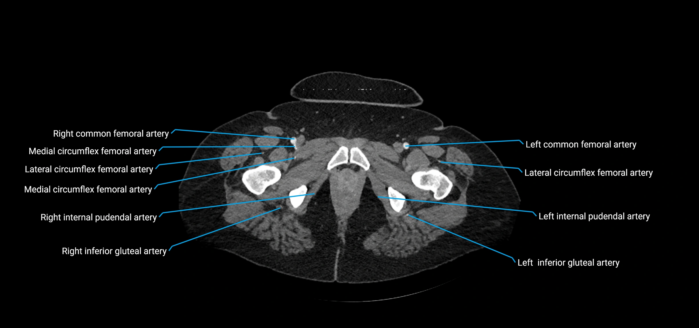CTA abdomen axial cross sectional anatomy labelled image_267 (2).webp